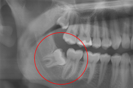 Un dente del giudizio in crescita impropria può provocare forti mal di testa prolungati.