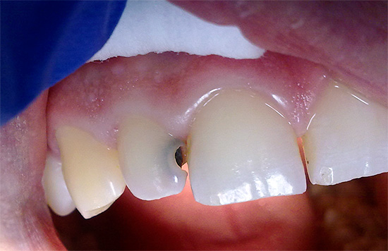 Con la carie profonda, un dente può diventare molto sensibile a una varietà di sostanze irritanti.