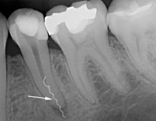 L'immagine mostra chiaramente un pezzo di uno strumento dentale rotto nel canale radicolare.