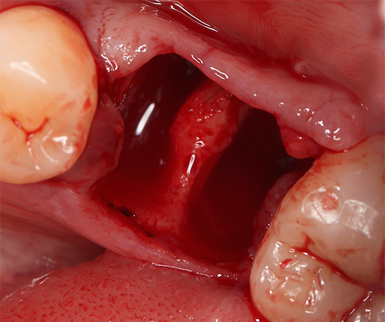 Vamos descobrir quanto tempo a gengiva cicatriza após o procedimento de extração do dente e como acelerar o processo de cicatrização ...
