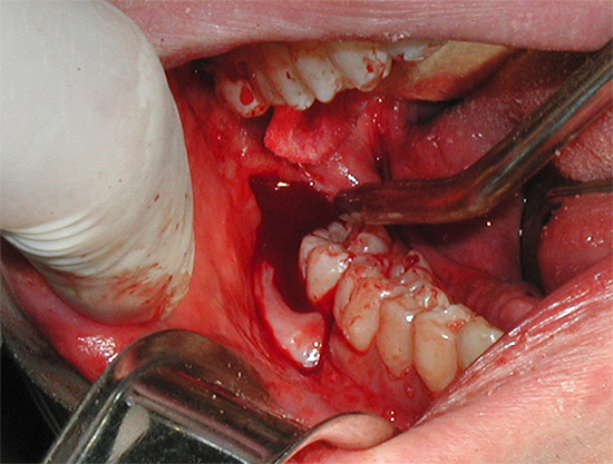 Com a extração complexa dos dentes do siso, ocorre um trauma grave nos tecidos moles ao redor ...