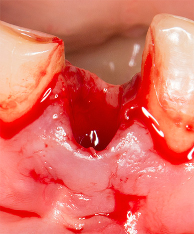 Com baixa coagulabilidade do sangue, é possível o sangramento muito prolongado de uma cavidade dentária.