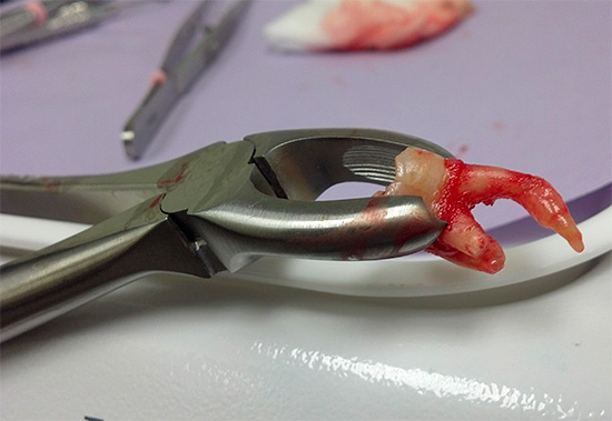Existem várias maneiras de acelerar o processo de cicatrização das gengivas após a extração do dente ...