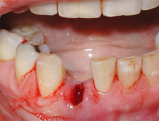 Um dos problemas que os pacientes enfrentam imediatamente após a extração do dente é o sangramento prolongado do orifício.