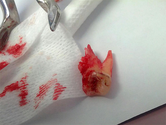 A foto mostra o dente do siso removido