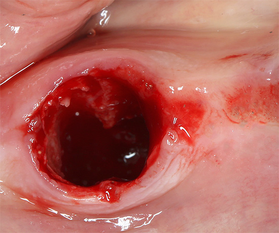 É muito importante que o orifício do dente seja preenchido com um coágulo sanguíneo, pois posteriormente protegerá a ferida de maneira confiável e segura da infecção.