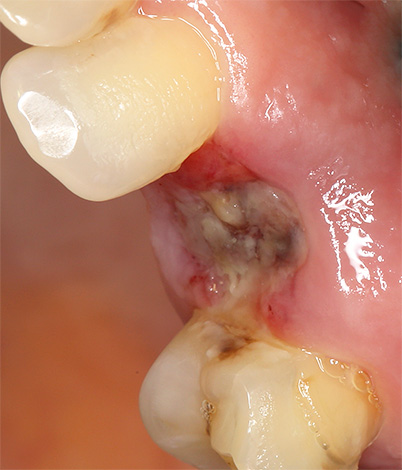 Se os resíduos de dentes cariados não forem completamente removidos do buraco, a ferida pode se deteriorar e curar muito lentamente.