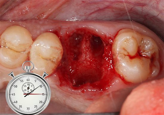 Como regra, a convergência das bordas das gengivas acima do orifício ocorre dentro de 2,5 semanas após a extração do dente.
