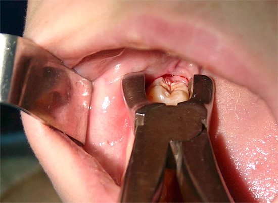 A extração dentária é um tipo de operação cirúrgica e, em alguns casos, em alguns casos, podem surgir complicações ...
