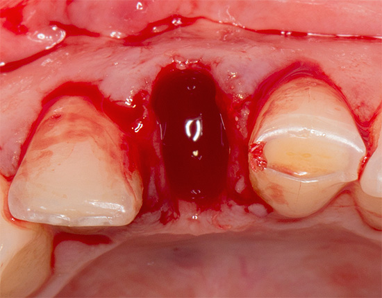 O sangramento covinha prolongado sempre tem suas causas, que era desejável identificar mesmo antes da extração dentária.