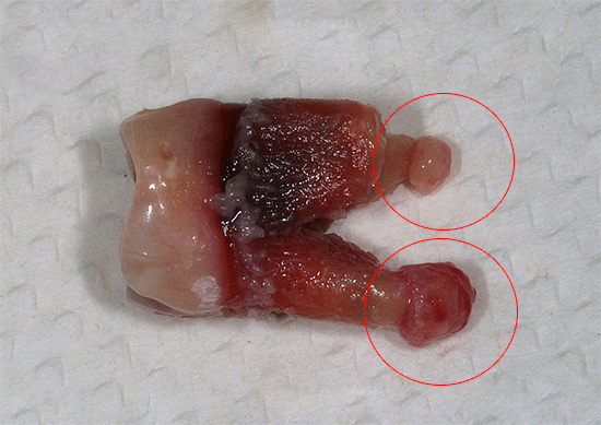 A foto mostra um dente com cistos nas raízes - se um pedaço dessa raiz permanecer no buraco, o paciente poderá desenvolver uma complicação séria ...