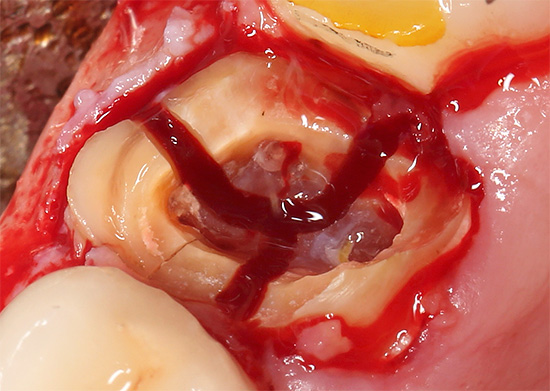 O dente é cortado em três partes para facilitar a extração da raiz.