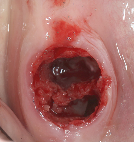 Com a supuração do orifício do dente, a alveolite se desenvolve
