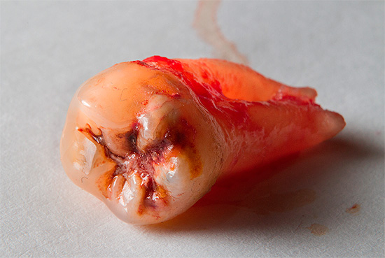 Frequentemente, o desenvolvimento de complicações está associado a uma alta invasividade do procedimento, por exemplo, à remoção não muito profissional de um dente do siso.