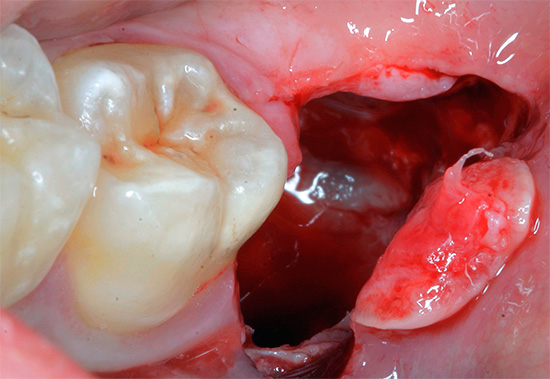 Existem vários sintomas e sinais típicos pelos quais uma complicação após a extração dentária pode ser reconhecida e não pode ser ignorada.