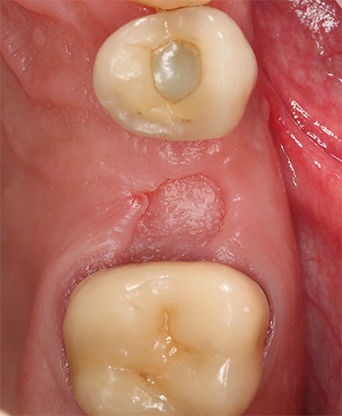 Fotografia de um furo dental curado