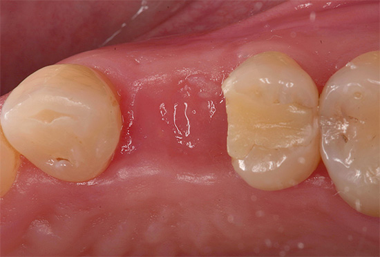 Mesmo que a gengiva lesionada tenha cicatrizado completamente, isso não significa que, no futuro, você não sentirá as consequências a longo prazo da extração dentária.