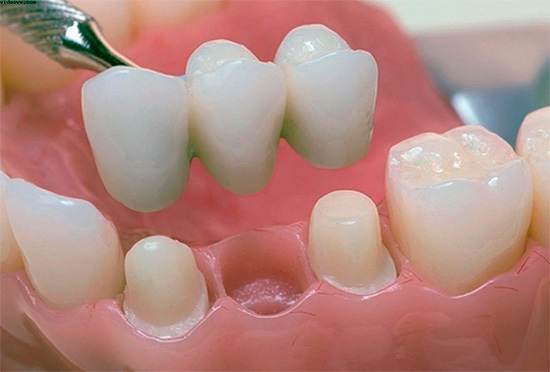 Essa ponte torna possível restaurar as funções de um dente perdido e evitar más oclusões no futuro.