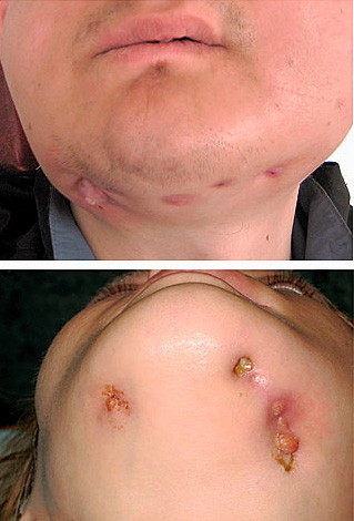 Nos casos mais graves, após a extração dentária sem tratamento adequado do processo inflamatório, pode ocorrer osteomielite mandibular.