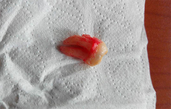 Mesmo que o dente seja removido com facilidade e competência, uma pessoa ainda pode perder a consciência assim que se levanta da cadeira odontológica - e isso deve ser levado em consideração.