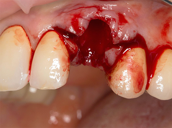 A foto mostra um novo dente