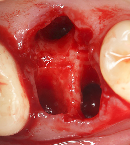 Às vezes, o sangramento de um orifício após a extração do dente é muito longo, até vários dias seguidos.