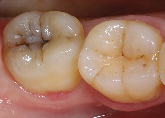 Conosciamo le caratteristiche della pulpite acuta purulenta e le difficoltà che spesso sorgono durante la sua diagnosi e trattamento ...