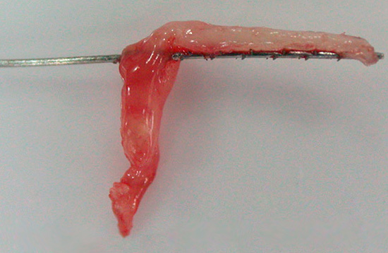 Ecco un altro esempio di nervo estratto da un dente.