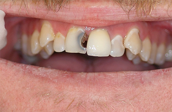 Se con la pulpite purulenta ritardano a lungo una visita dal dentista, il dolore a volte può davvero scomparire, ma in futuro non porterà a nulla di buono senza trattamento.