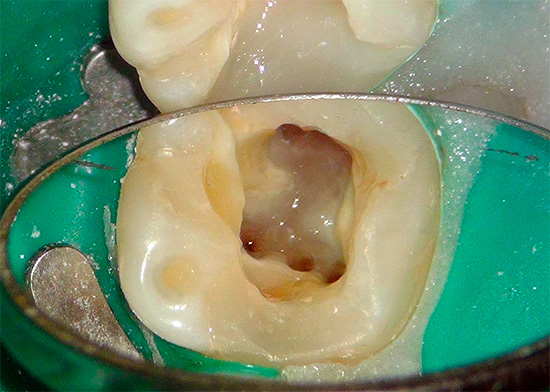Il trattamento dei canali con pulpite costa molto e più sono nel dente, più costoso costerà per il tuo portafoglio.