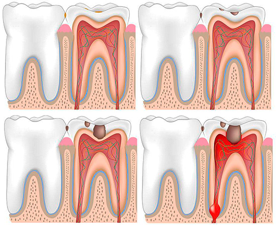 L'ingresso di batteri attraverso la carie cavità nella camera pulpare del dente porta inevitabilmente all'infiammazione della polpa - e questo è il meccanismo più comune per lo sviluppo della pulpite acuta.
