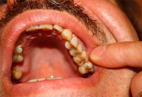Se il paziente può indicare accuratamente un dente cattivo, nella maggior parte dei casi ciò corrisponde alla forma sierosa di pulpite.