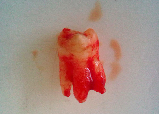 L'incapacità del paziente di determinare con precisione la fonte del dolore a volte porta al fatto che il dentista-chirurgo rimuove un altro dente relativamente sano, o addirittura nessuno ...