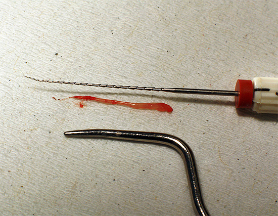 La fotografia mostra la polpa estratta dal canale radicolare del dente