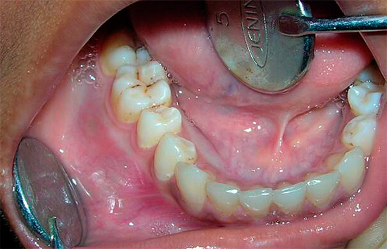 Per alleviare le cause dei mal di denti in modo affidabile, in molti casi il dentista non sarà in grado di fare a meno dell'intervento.