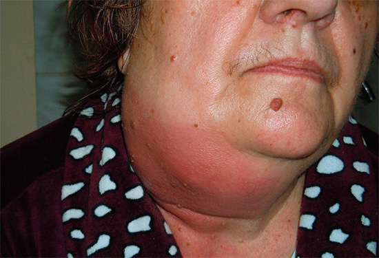 La foto mostra un flemmone odontogeno - un'infiammazione pericolosa per la vita.
