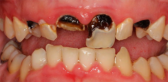 Se fai affidamento solo su cospirazioni e non vai dal dentista per molto tempo, le condizioni dei denti possono diventare molto deplorevoli.