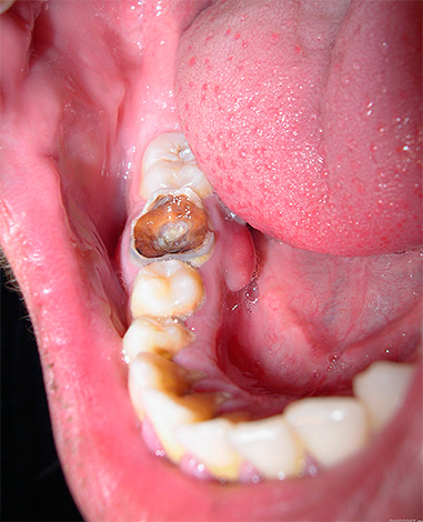 Anche la cospirazione più forte non porterà al ripristino dei tessuti duri di un tale dente.