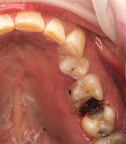 Con questa condizione dei denti, è meglio non cercare una forte cospirazione dal dolore, ma un buon dentista.
