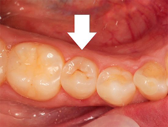 Anche se non c'è ancora dolore, ma il dente è affetto da carie, è meglio guarire il più rapidamente possibile.