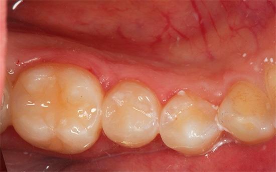Una fotografia di un dente dopo il trattamento e il riempimento.