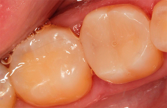 E sembra lo stesso dente dopo aver installato il sigillo.