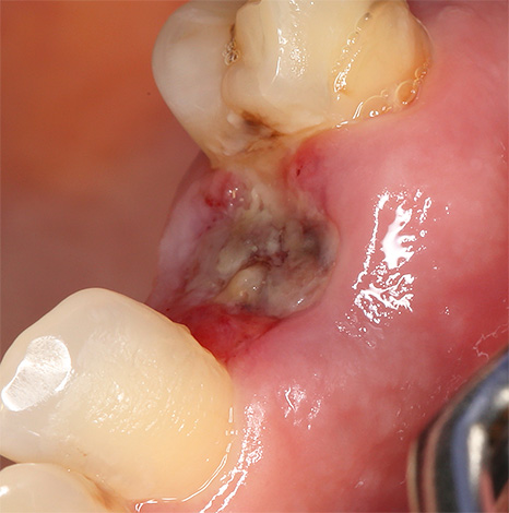 Vamos falar sobre alveolite - uma complicação desagradável que geralmente ocorre após a extração do dente e se manifesta por inflamação e supuração do orifício, o que reduz a taxa de cicatrização.