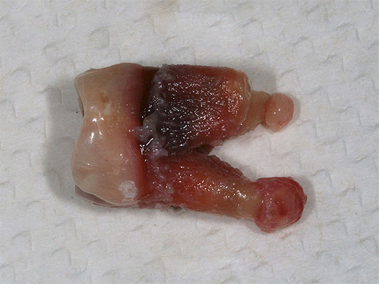 E esta foto mostra um dente extraído real com cistos nas raízes.