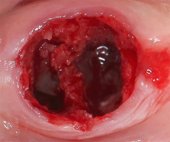 Se um coágulo de sangue protetor não se formar bem no dente, a probabilidade de desenvolver alveolite aumenta acentuadamente.