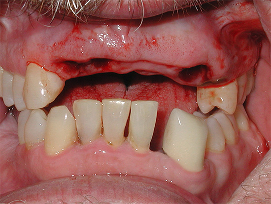 Se for difícil procurar um médico, os sintomas da alveolite podem ser aliviados em casa, especialmente se você fizer o tratamento a tempo.