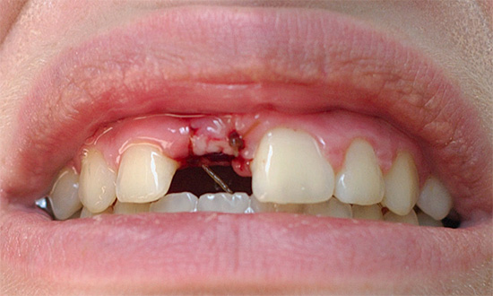 Mesmo que o buraco do dente após o autotratamento tenha deixado de apodrecer, você ainda deve procurar o aconselhamento de um dentista.