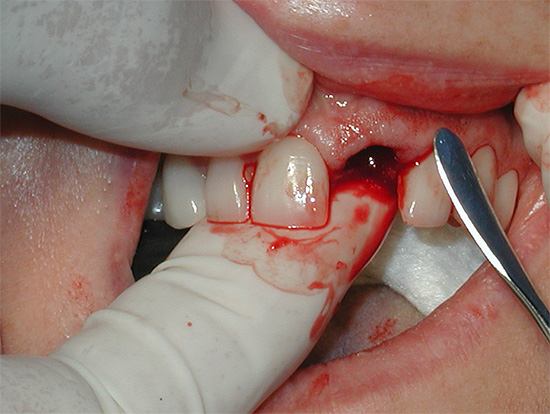 Durante o tratamento da alveolite, o médico geralmente atualiza a ferida, garantindo assim a formação de um coágulo protetor no sangue.