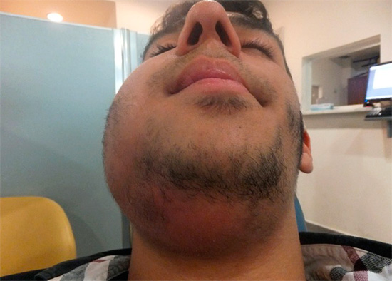 Phlegmon é uma inflamação aguda (difusa) extensa do tecido adiposo.