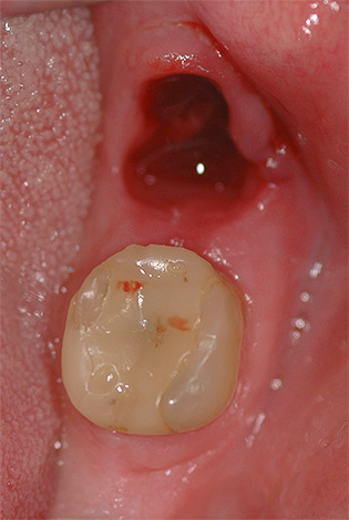 A alveolite pode ser tratada em casa, mas na maioria dos casos ainda será necessária uma visita ao dentista.